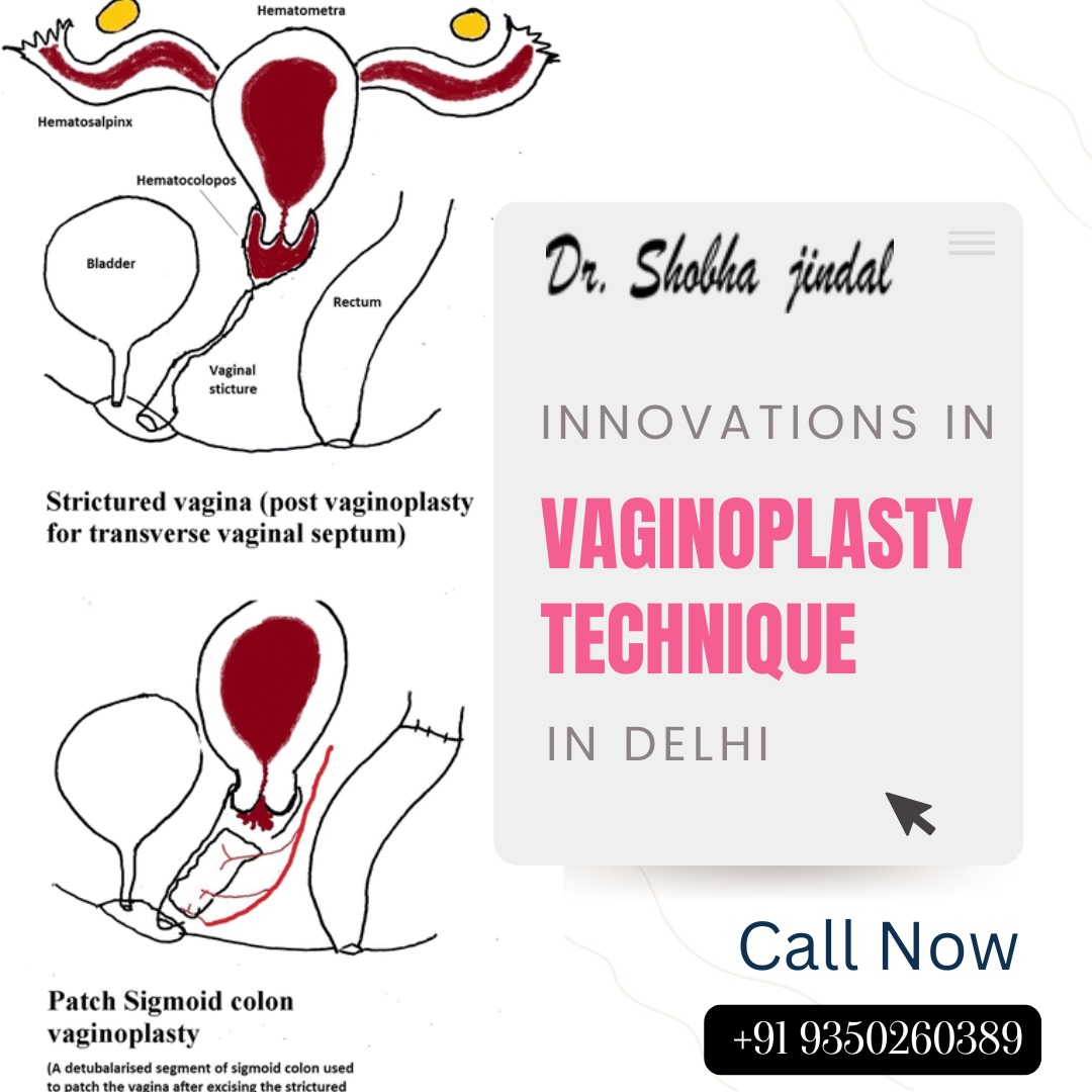 vaginoplasty techniques