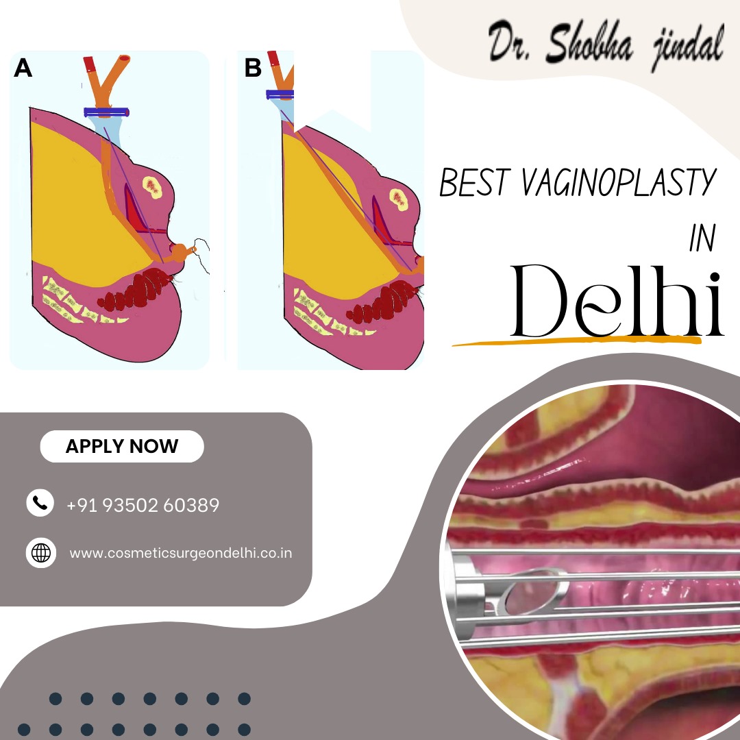 Best Vaginoplasty in Delhi