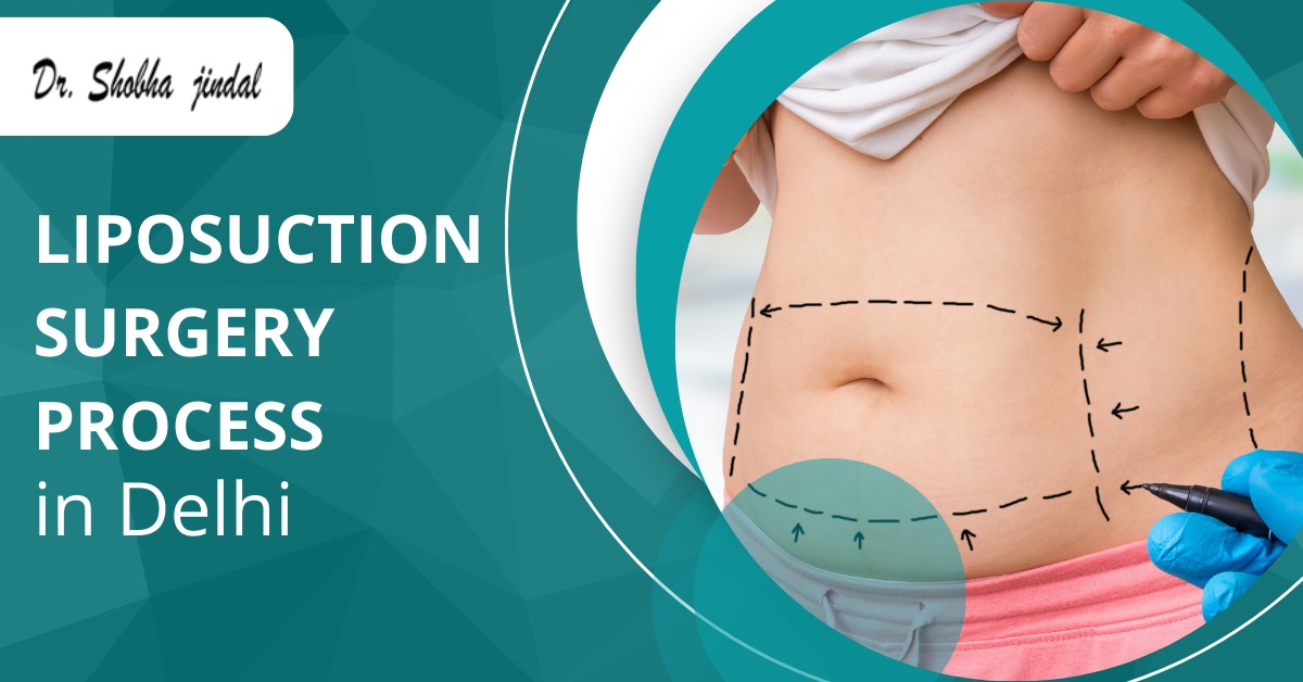 Liposuction Surgery Process in Delhi