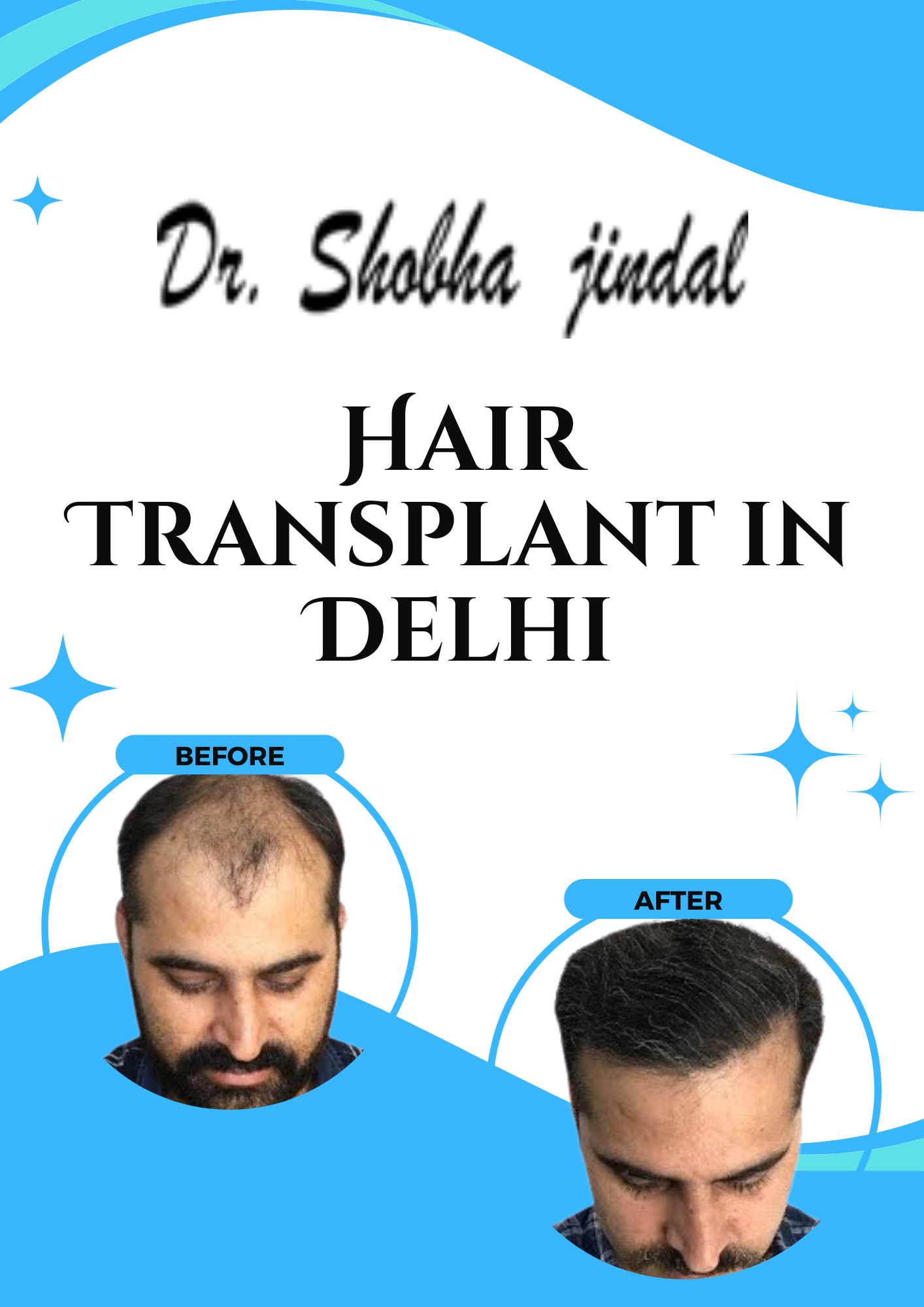 Best Hair Transplant in Delhi