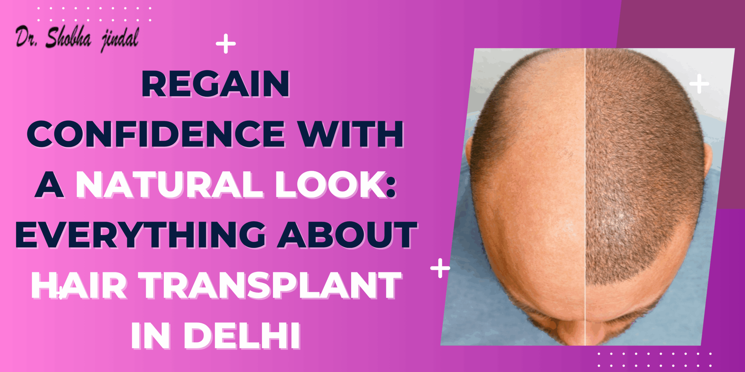 Hair Transplant in Delhi