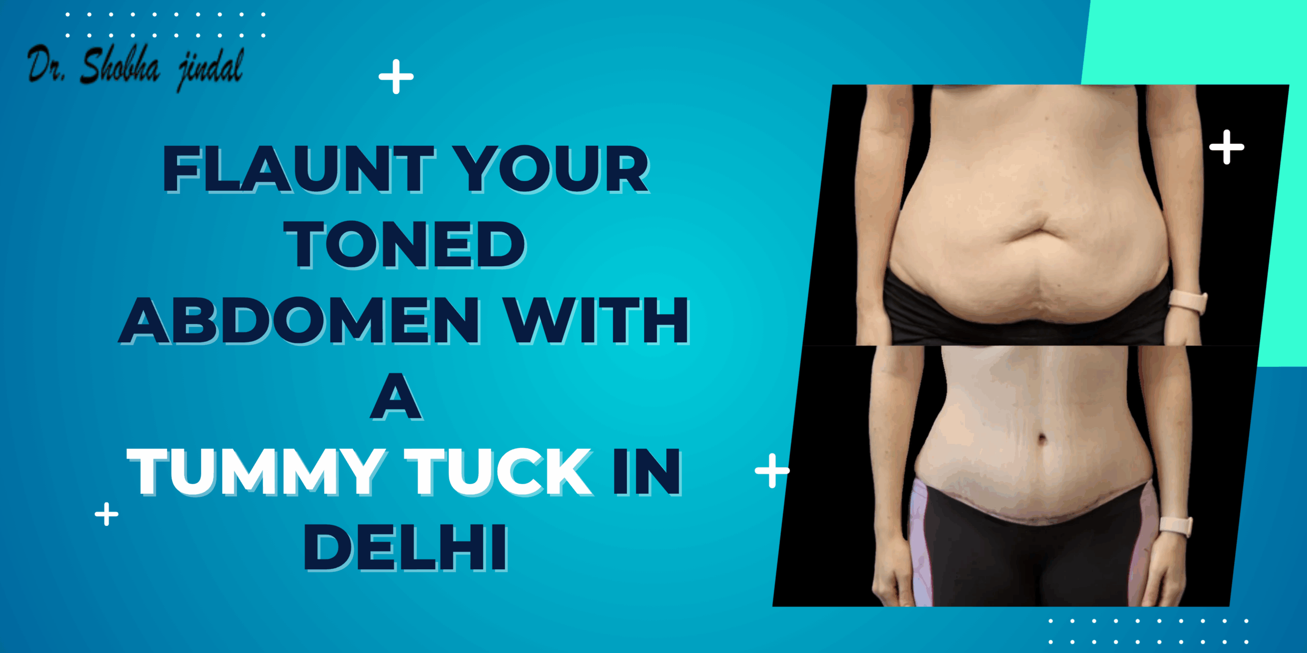 Tummy Tuck in Delhi