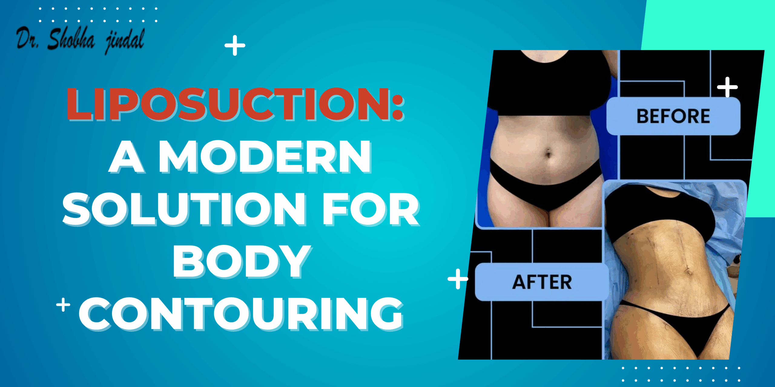 Liposuction